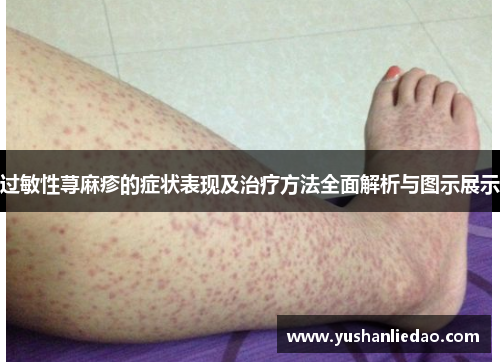 过敏性荨麻疹的症状表现及治疗方法全面解析与图示展示