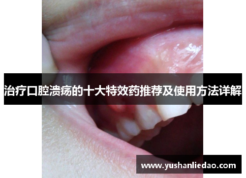 治疗口腔溃疡的十大特效药推荐及使用方法详解